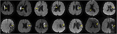 Diffusion-weighted imaging hyperintensities during the chronic stage of intracerebral hemorrhage with surgery: A new clinical situation or post-surgery artifact?